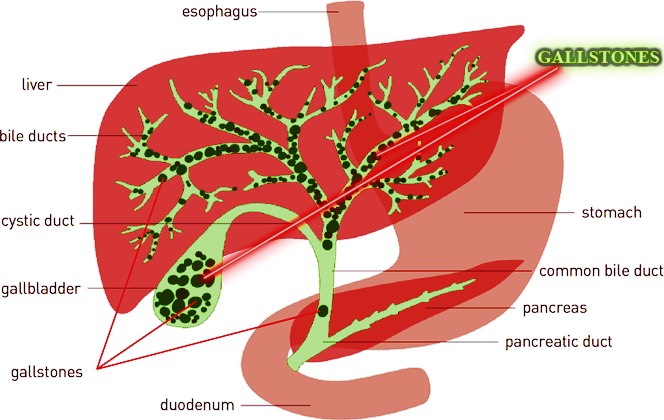 Image result for gallbladder and liver detox steps